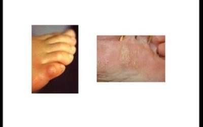 Corns and Callus on your Feet