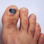 Foot with subungual haematoma