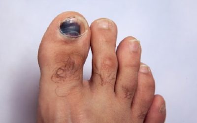 What causes Black Toenails?