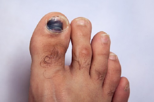 Foot with bruised big toe nail
