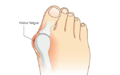 Am I too young to have a Bunion?