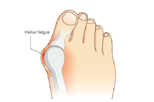 Am I too young to have a Bunion?