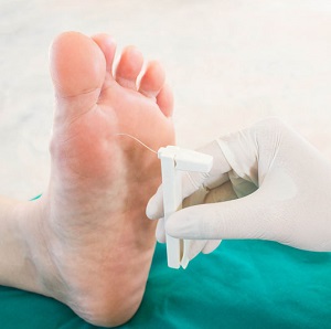 Podiatrist testing foot with monfilament