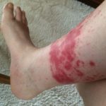 Swollen Leg with Rash