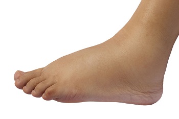 swollen foot of young pregnant woman