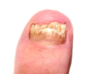 Damaged toe nail before cosmetic toenail restoration