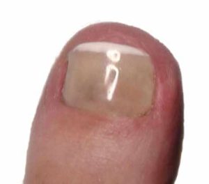 Toe nail after cosmetic toenail restoration