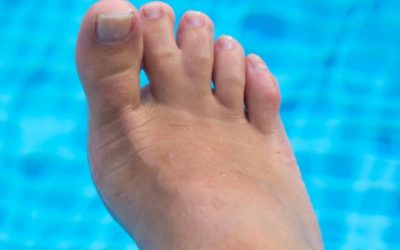Are Webbed Toes Bad?